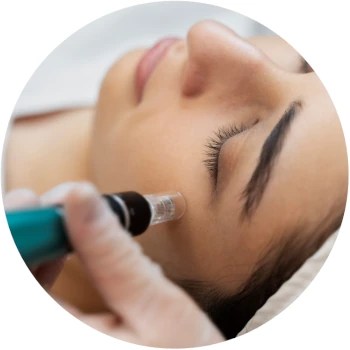 Professional Microneedling Treatment for Skin Rejuvenation at Bonita Laser in Mississauga